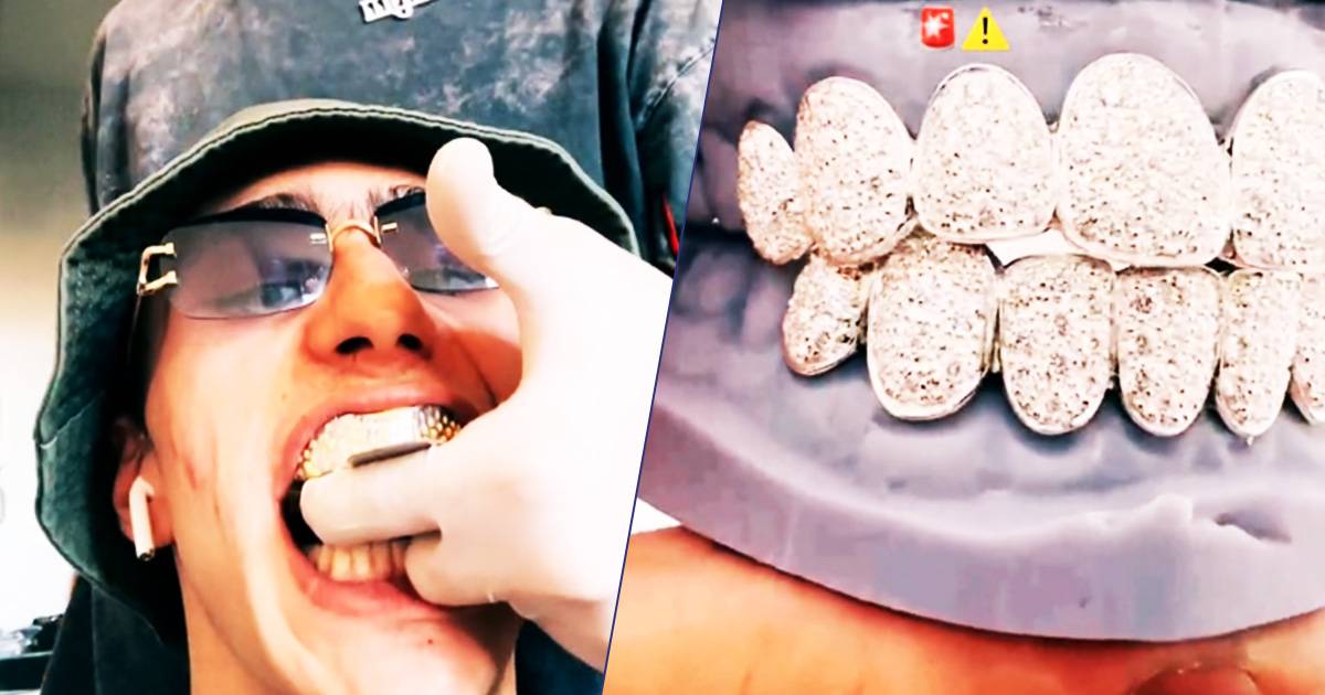 Achille Costacurta diventa virale il video in cui mostra i nuovi denti di diamante